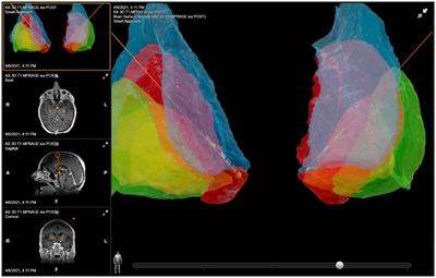 Deep brain stimulation programming for intractable obsessive–compulsive disorder using a long pulse width